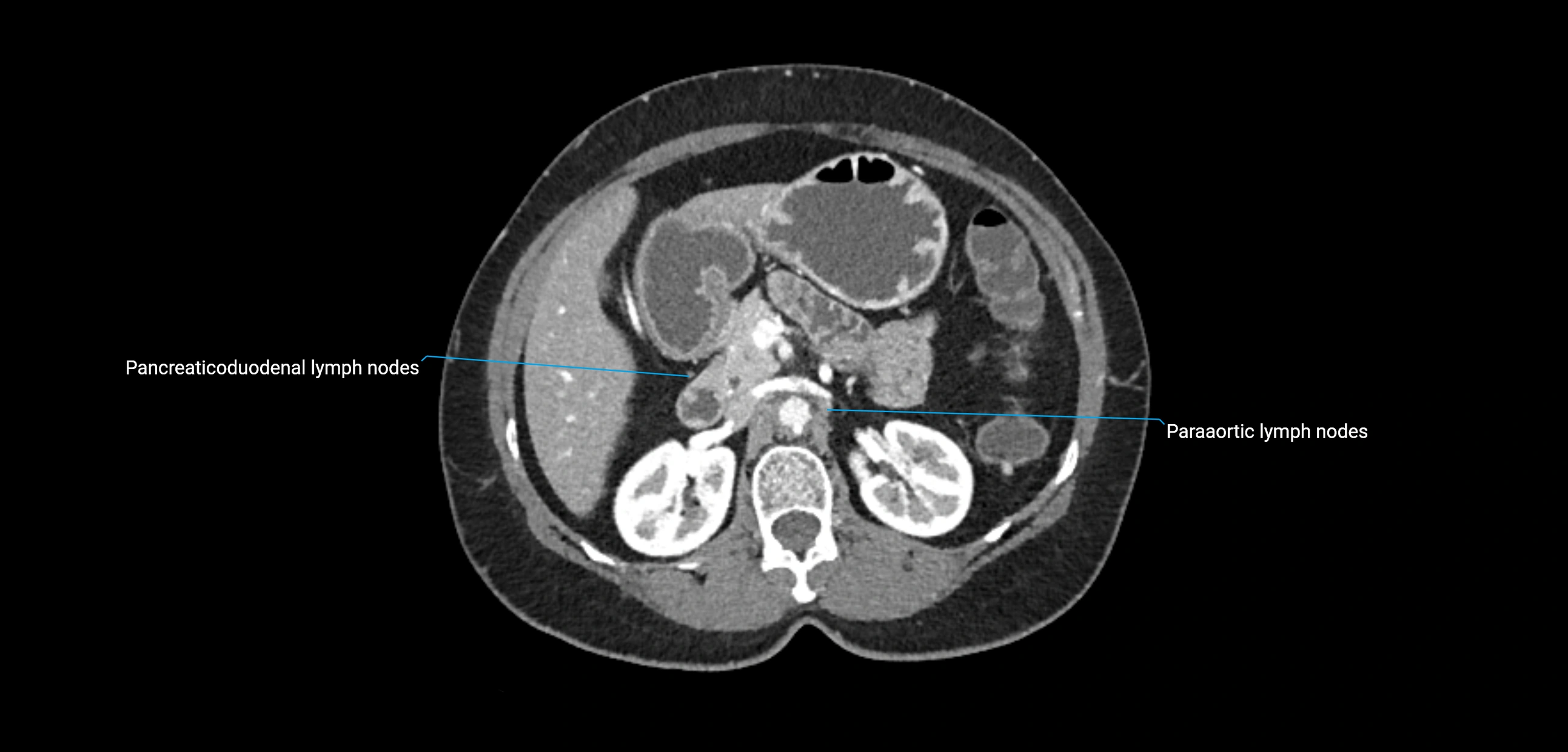 CT ct abdominal lymph nodes  axial cross sectional anatomy  enchanced radiology image -img-00002-00165.webp